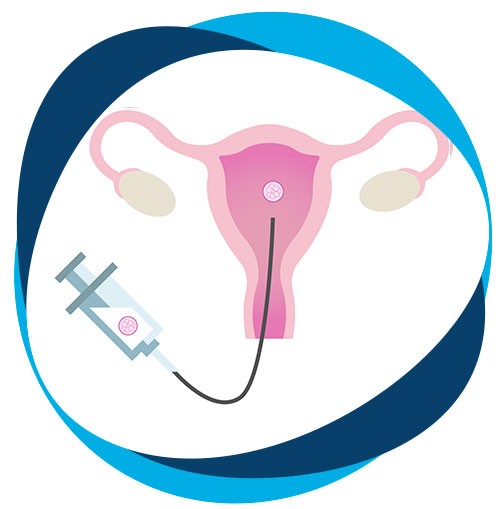 Transferencia embrionaria