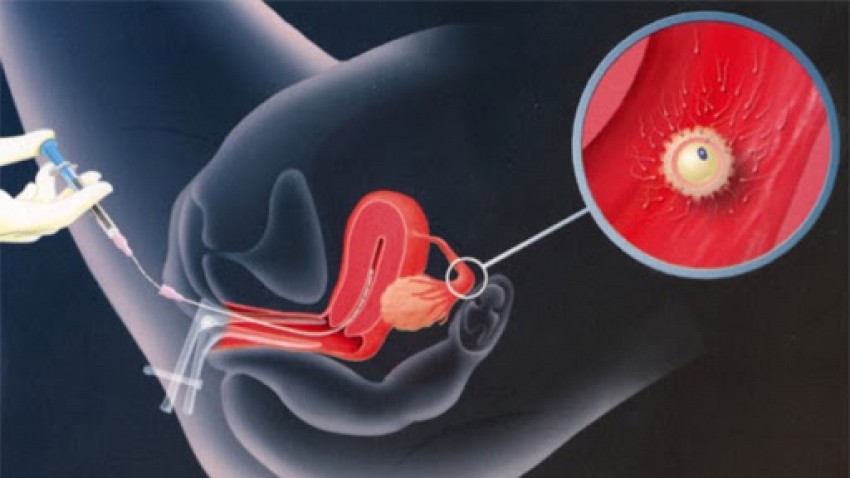 Inseminación intrauterina