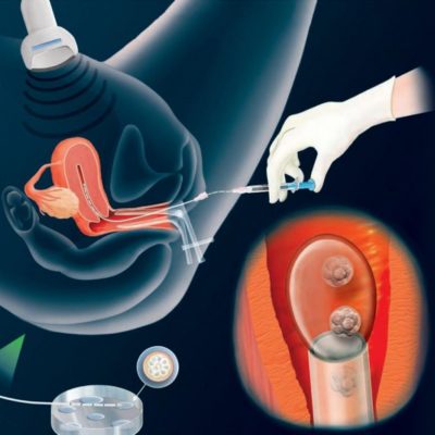 Transferencia embrionaria